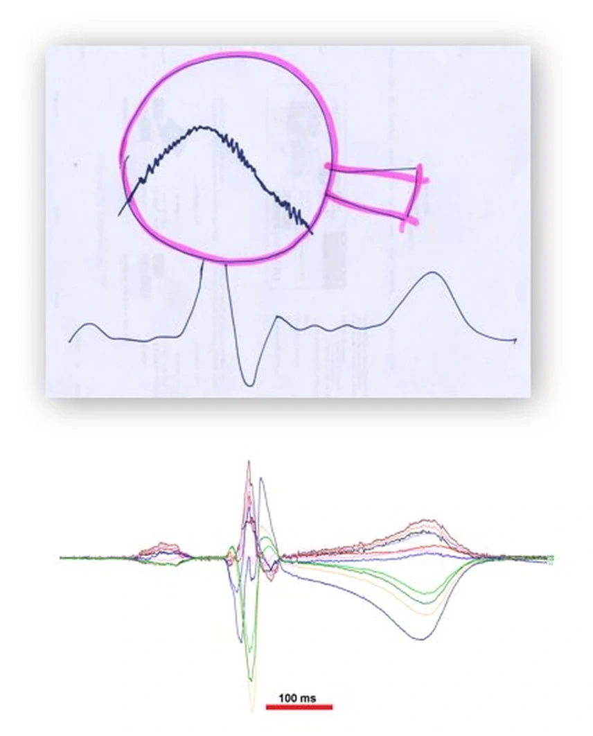 Early ultra-high-frequency ECG signal analysis