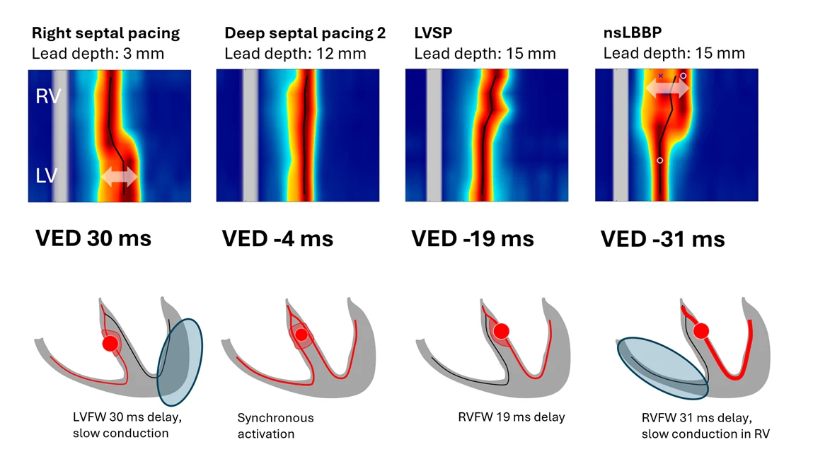 Non-invasive conduction system pacing guidance using UHF-ECG