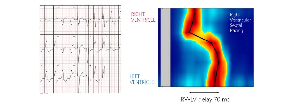 UHF-ECG Activation Map