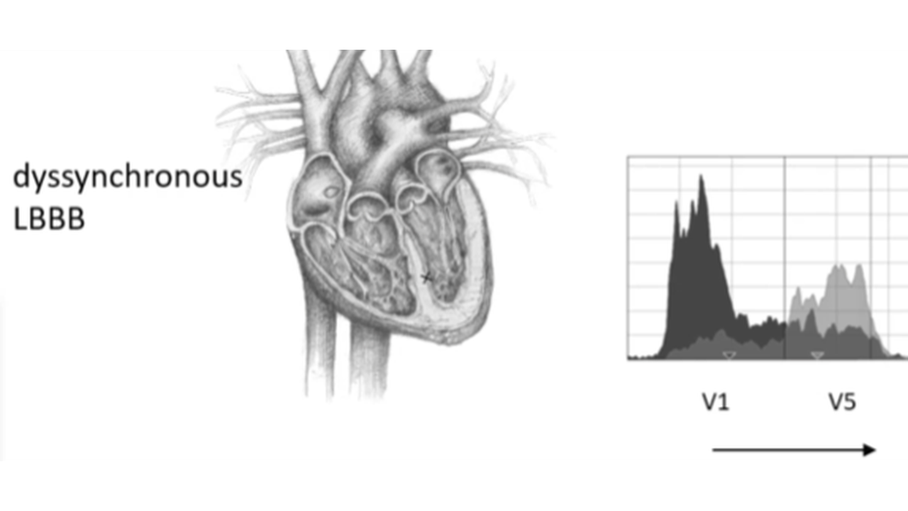 Preview of dyssynchronous UHF-ECG activation video