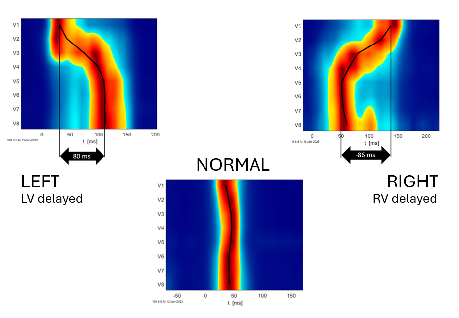 UHF-ECG activation patterns