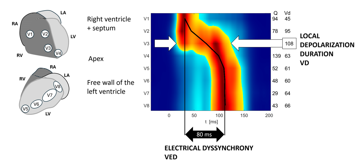 UHF-ECG ventricular activation map and local depolarization duration